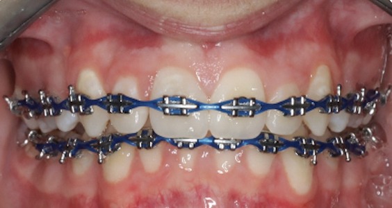 After Teeth